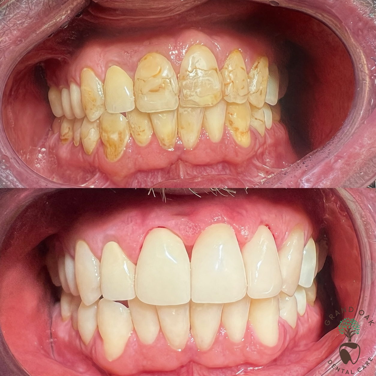 Same-Day EMAX Crown & Cosmetic Bonding